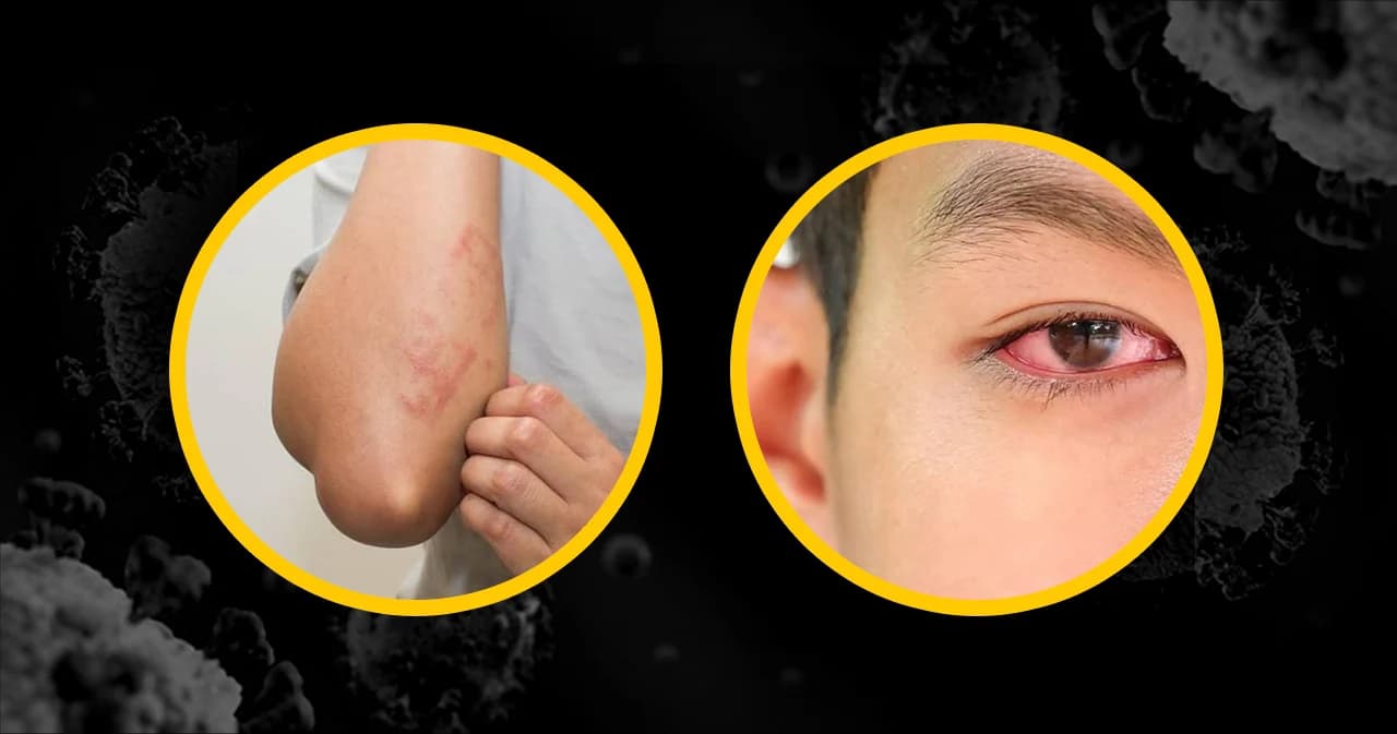 สังเกตลักษณะอาการใหม่ป่วยโควิด-19 ตาแดง มีผื่นขึ้น